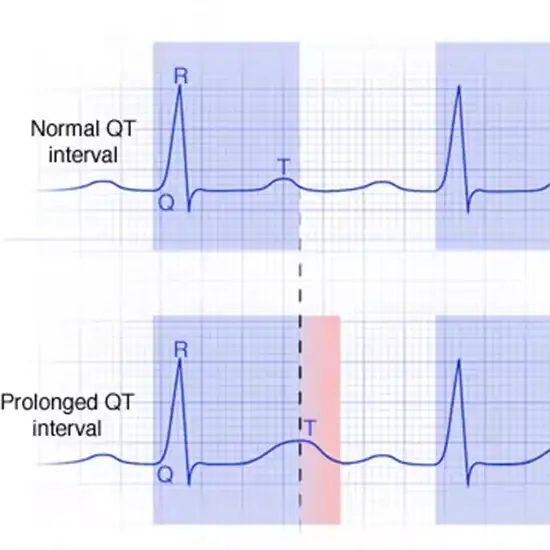 genetic testing for long qt syndrome
